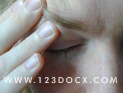 Migraine Headache Photo Image